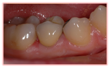 Corona metal ceramica in sito